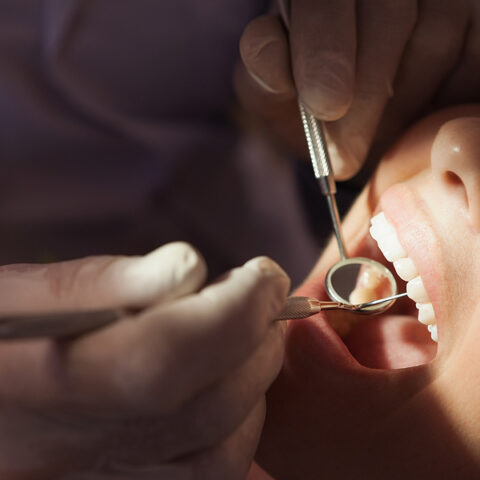 Cosmetic crowns and bridges in Geelong